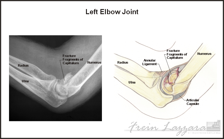 Low-Range: elbow illustrations showing injury and medical hardware per films